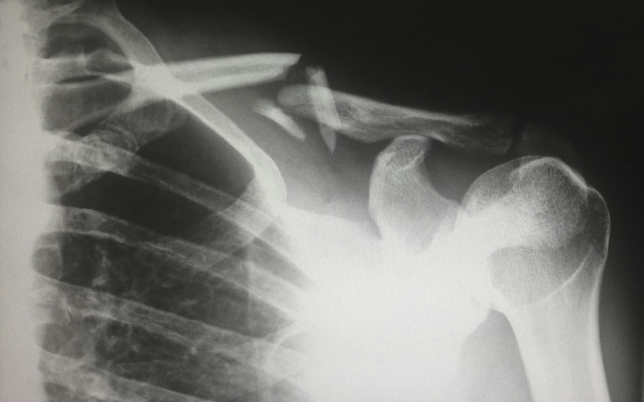 x-ray of a broken bone