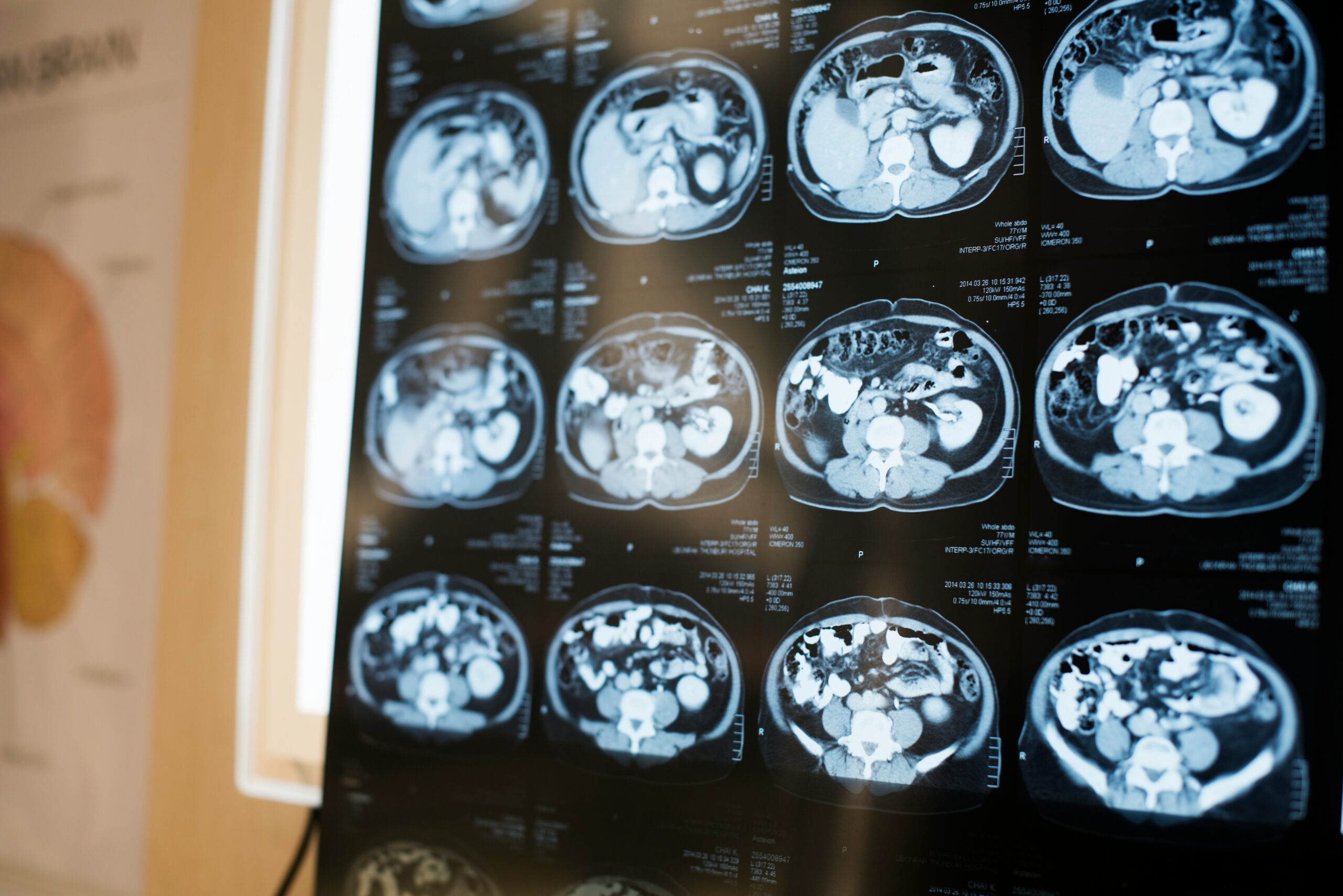 Medical imaging film displaying multiple abdominal CT scan cross-sections arranged in a grid, showing internal organs and structures in grayscale, illuminated against a lightbox with clinical labels and markings visible.